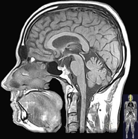 MRI: escaneo por resonancia magnética