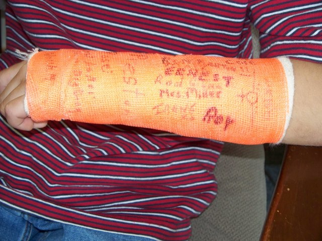 Mi primer hueso roto