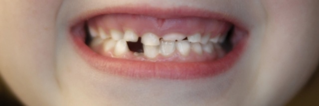 Gracie lost her first tooth