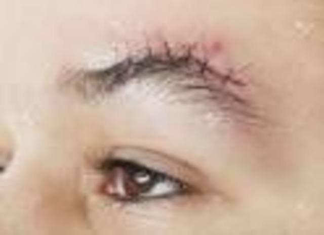 First time getting stitches