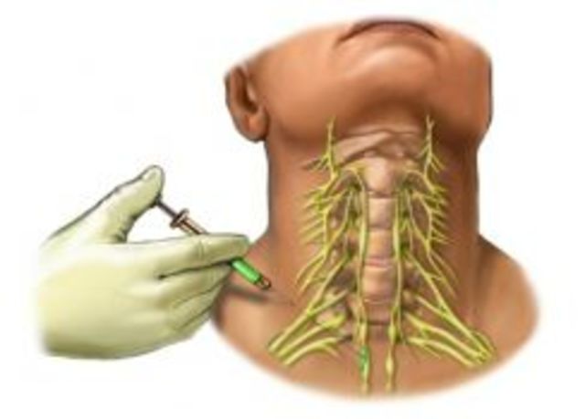 Stellate Ganglion Block Proves Effective for the Treatement of PTSD