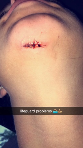 Got My First Stitches