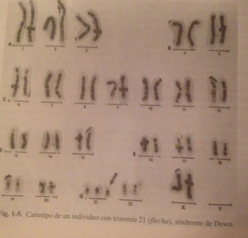Sindrome de down