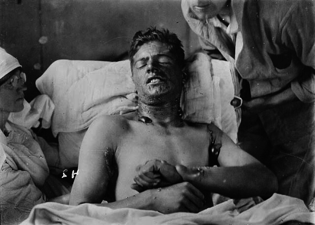Mustard Gas