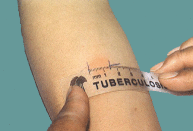 Tuberculina