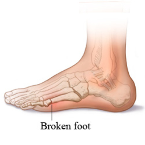 I broke my foot
