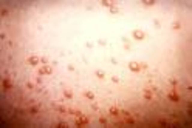 Vaccine for Chicken Pox is discovered