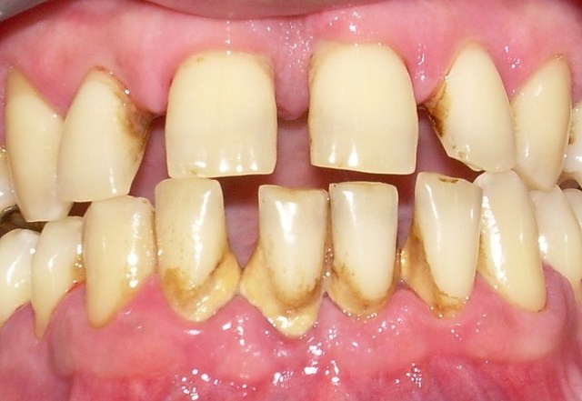 Enfermedad periodontal y cavidades dentales.