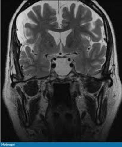 Teoría panhipopituitario de la anorexia