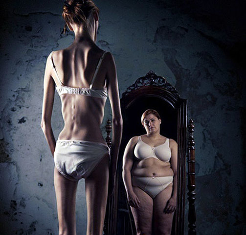 Anorexia nerviosa