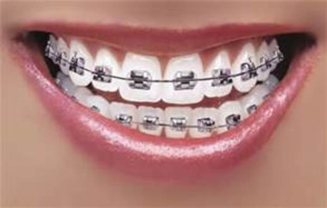 Got Braces :/