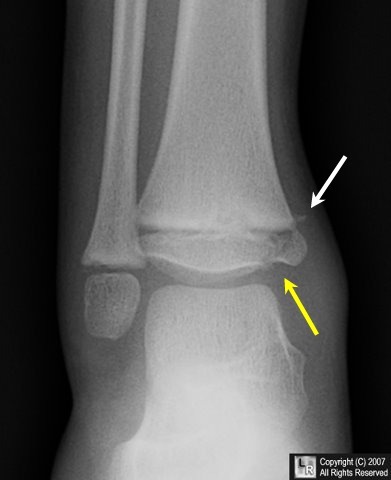 Broke My Ankle for The 1st time