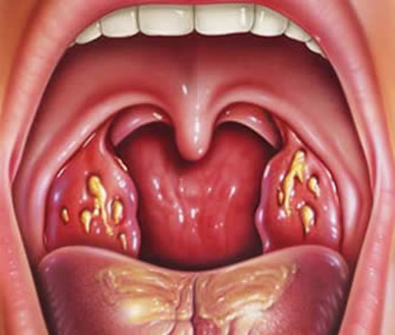 I got sick of angina