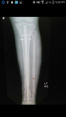 My father got into a motorcycle accident