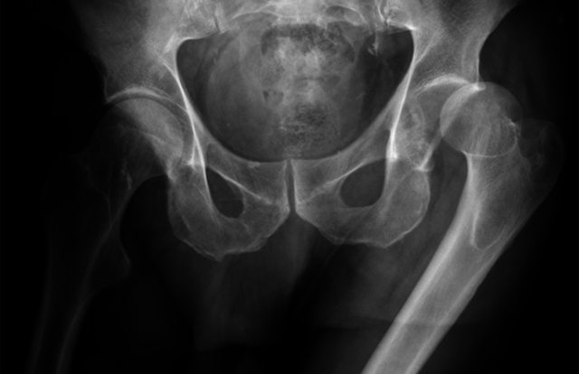 Hip dislocation