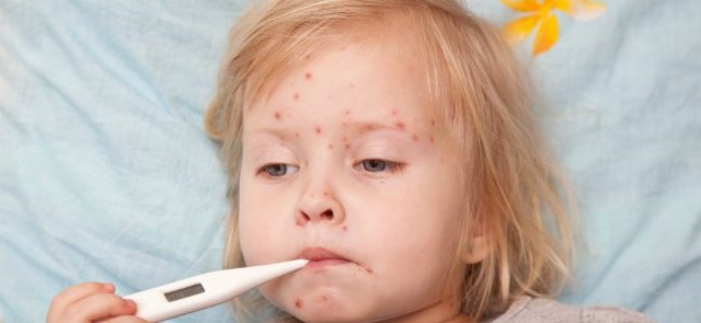 2 years ago chickenpox