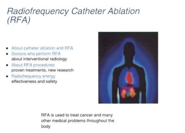 HWI - RF Catheter Ablation