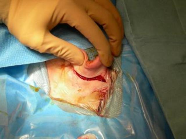 First cochlear implant surgery