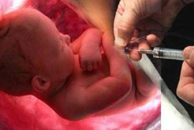 Se había puesto rutinario a "eutanizar" a los bebés nacidos con impedimentos. Como espina bífida.