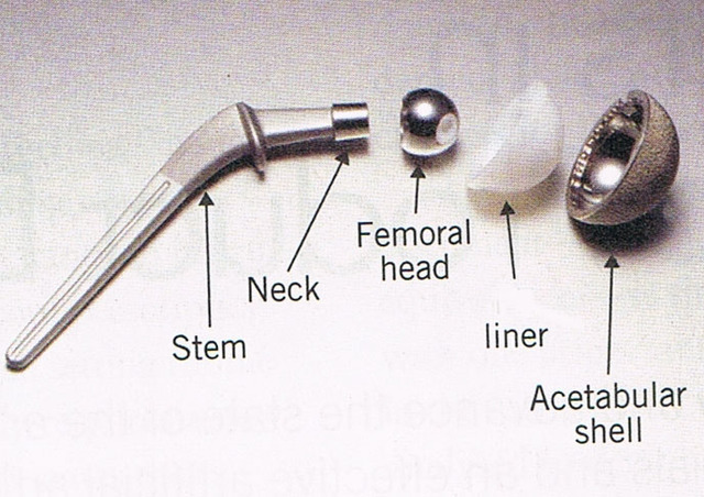First artificial hip replacement