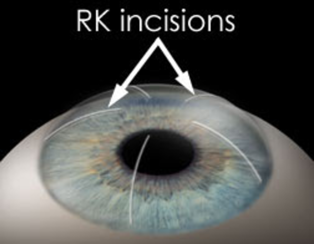 Radial Keratotomy