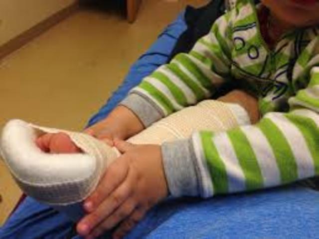 yo rompi mi pierna, mi pierna daño mucho