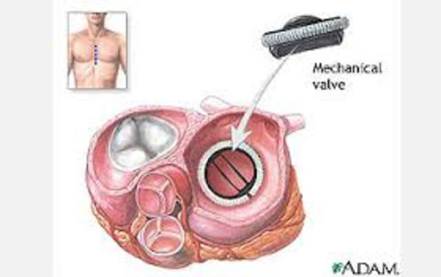 Artificial heart valve developed