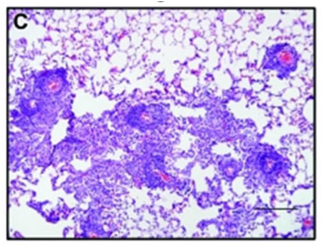 First cases of Pneumocystis carinii pneumonia were discovered.