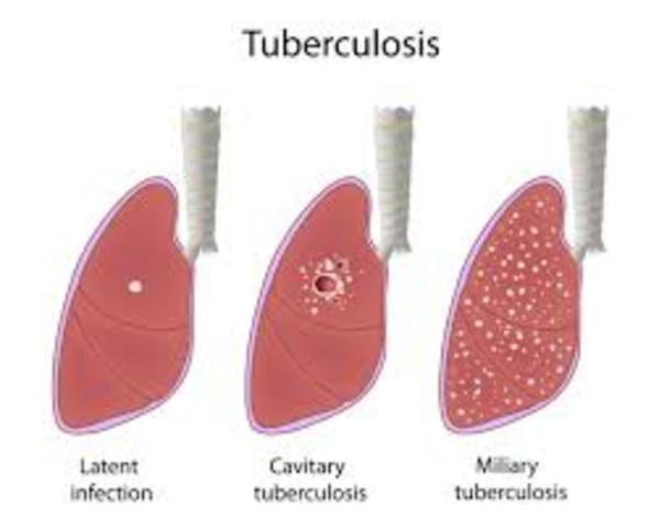 First vaccine for tuberculosis.
