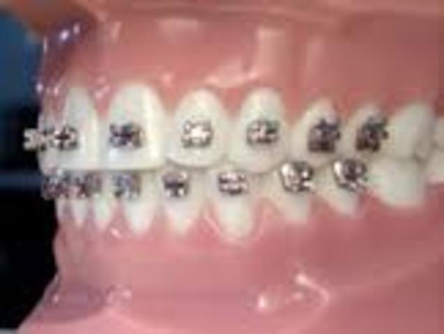 The day I got braces :(