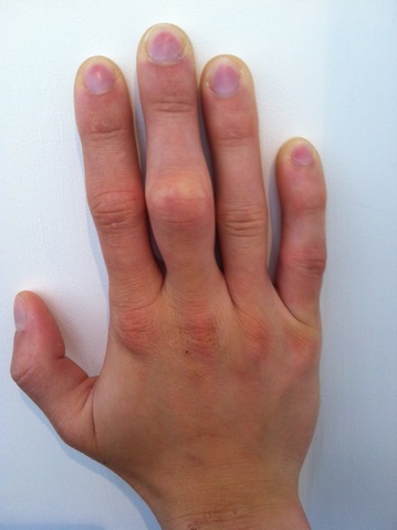 The day I broke my knuckle