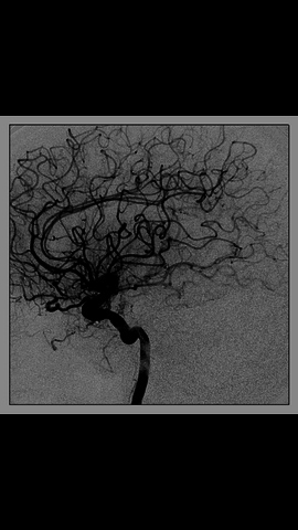 Cerebral Angiography