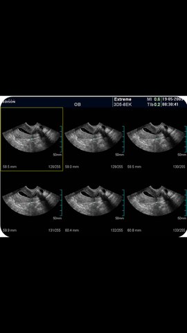 Hysterosonography