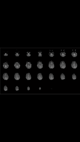 Echo plannar imaging