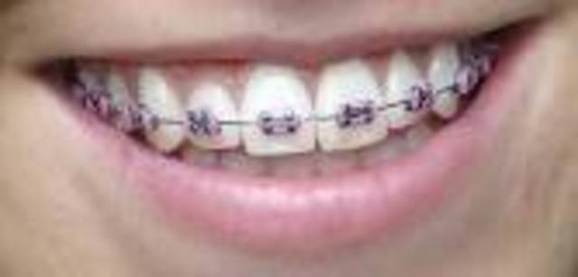 I Get Braces!