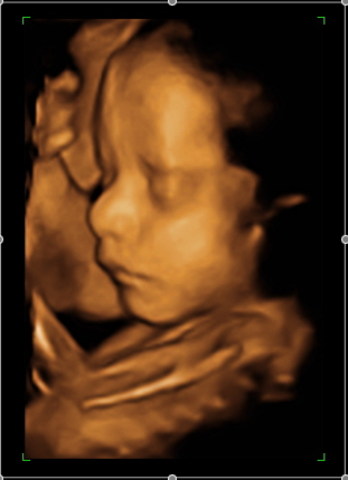 3D Ultrasound was created.