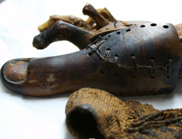 First Prosthetic Leg