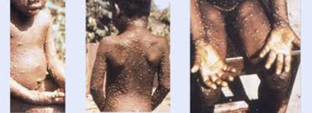 Monkey pox discovery
