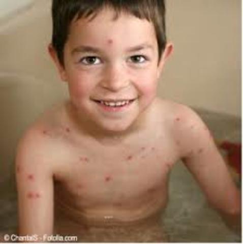He had chickenpox