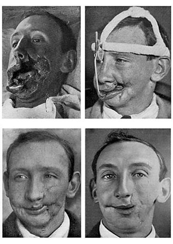 WW1 Sparked Plastic Surgery
