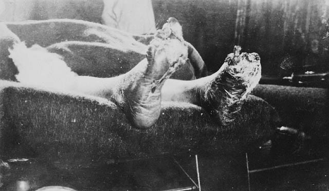 Trench Foot