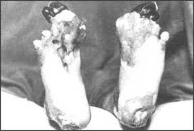 Trench foot