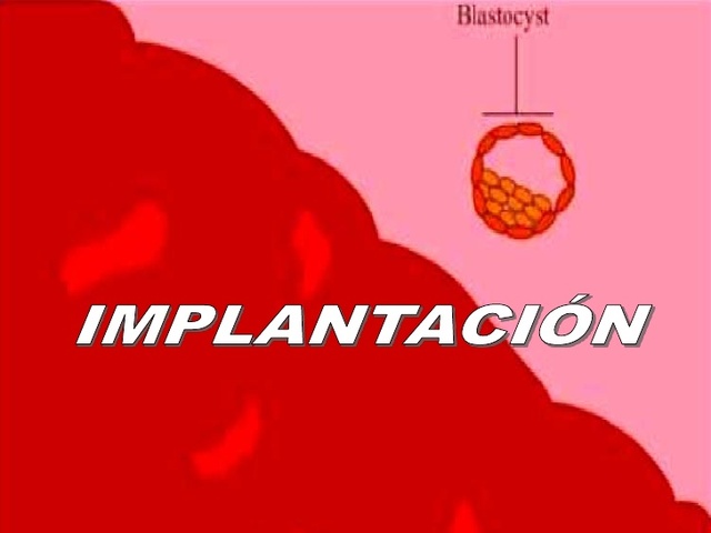 Implantación