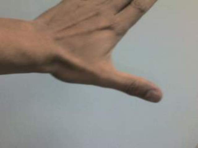 when I burned my hand