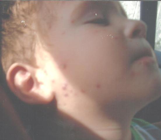 I had chickenpox