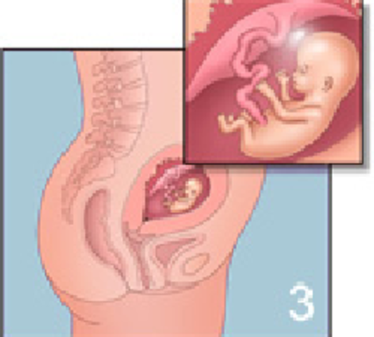 12ª semana (3º mes).