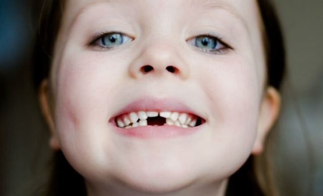 Caida de los dientes de leche