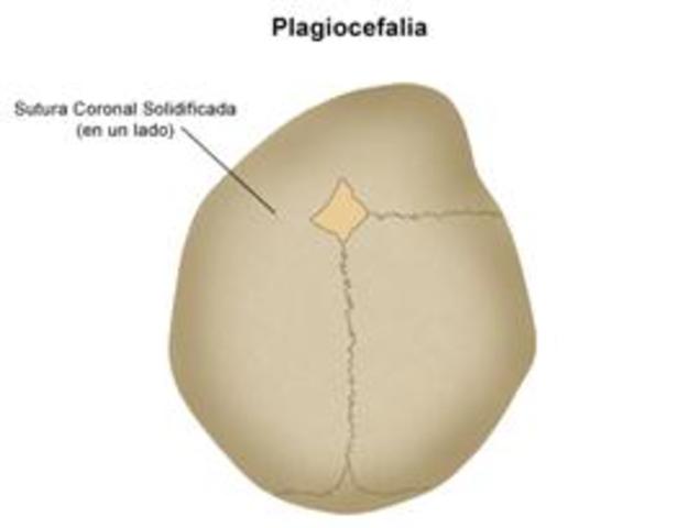 Cierre de sutura craneal
