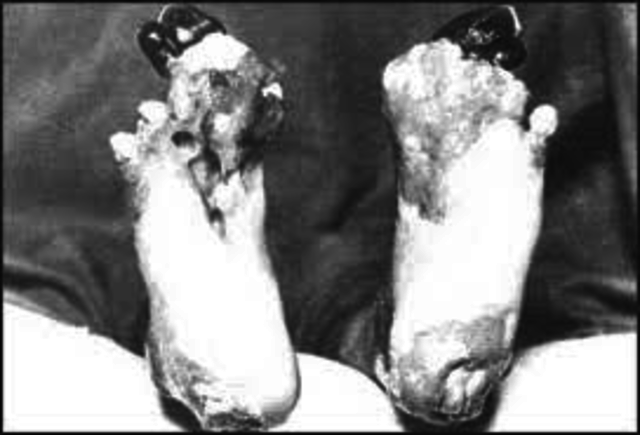 Trenches lead to Foot Infections