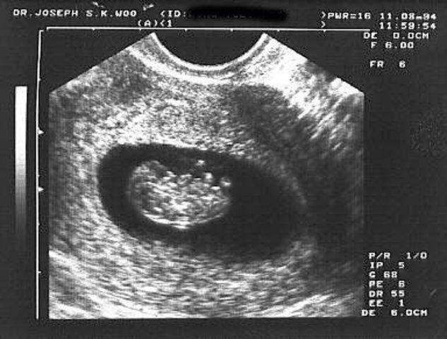 First ultrasound